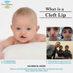 A cleft lip, which more often than not comes with a cleft palate as well, is a deformity where the lips of the baby's mouth aren't joined properly to the face on the upper lip. It appears to be like a slit on the upper lip that runs to the nose. In most cases, this is accompanied by the cleft palate where the slit may have the shape not just superficially, but the roof of the mouth may also be carved out in a similar shape.

Dr. Ajaya Kashyap Triple American Board certified Plastic Surgeon with over 30 years of experience in which 16 years in the U.S.A. & from the past 14 years he is in Delhi. You can learn more about him and see some of his patient's "before and after" pictures on his website - www.bestfacesurgeryindia.com

We are offering VIRTUAL CONSULTATIONS so that we can all stay connected during this time! book your consultation by visiting bestfacesurgeryindia.com and click the link on the websites homepage

#cleftlip #cleftliptrepair #cleftpalate #cosmeticsurgery #plasticsurgeon #bestfacesurgeryindia #drkashyap #delhi #india
