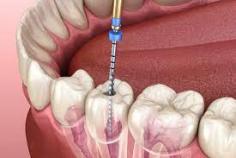 Root Canal Treatment: When And How Requires


Most of the people pay a visit to the Heights Dentist Houston just only at the time they begin to come into contact with serious pain and ache in their teeth so for them the cause is still fiction.

https://sapphiredental.netboard.me/teethwhiteningd/?tab=333698

