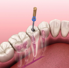 Well, the first and foremost question arises for the same from the patient side is “What is a root canal?”, as lots of people are not familiar with its actual functioning. So the answer is a root canal is a dental course of action with the assistance of a root canal dentist which appertains to the taking away in respect of the soft-sided center related to the tooth, referred to as the pulp.

