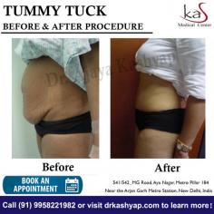 A tummy tuck, also known as abdominoplasty, removes excess fat and skin and restores weakened muscles to create a smoother, firmer abdominal profile. If you are thinking about getting a Abdominoplasty procedure in Delhi, set up an appointment with Dr. Ajaya Kashyap and discuss it. 

Dr. Ajaya Kashyap Triple American Board certified Plastic Surgeon with over 30 years of experience in which 16 years in the U.S.A. & from the past 14 years he is in Delhi. You can learn more about on his website - www.drkashyap.com

We are offering VIRTUAL CONSULTATIONS so that we can all stay connected during this time!

#tummytuck #tummytucksurgery #abdominoplasty #abdominoplastycost #abdominoplastysurgeon #cosmeticsurgery #plasticsurgery #DrAjayaKashyap
