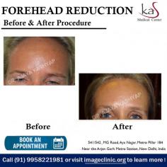 A forehead reduction surgery is a cosmetic procedure that helps reduce the height of a person’s forehead.

Dr. Ajaya Kashyap Triple American Board certified Plastic Surgeon with over 30 years of experience in which 16 years in the U.S.A. & from the past 14 years he is in Delhi. You can learn more about on his website - www.imageclinic.org

We are offering Video Consultation so that we can all stay connected during this time! 

#foreheadreduction #foreheadshortening #CosmeticSurgery #PlasticSurgeon #Drkashyap #Delhi #India #medicaltourism
