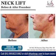 A neck lift is a cosmetic procedure that removes excess skin and fat around your jaw line, creating a more defined and youthful-looking neck. If you are thinking about getting a Neck Lift procedure in Delhi, India, set up an appointment with Dr. Ajaya Kashyap and discuss it. 

Dr. Ajaya Kashyap Triple American Board certified Plastic Surgeon with over 30 years of experience in which 16 years in the U.S.A. & from the past 14 years he is in Delhi. You can learn more about on his website - www.drkashyap.com

We are offering VIRTUAL CONSULTATIONS so that we can all stay connected during this time! 


#necklift #cosmeticsurgery #plasticsurgeon #realpatient #drkashyap #delhi #india
