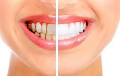 What are the two ways of having a pearly white smile?

As you can understand by the name, teeth whitening products that can make a smile bright through the help of whitening teeth can be named teeth bleaching. They are important products in every aspect that it can help your teeth to get shiny and pearly bright to make it beautiful for the cosmetic thing and also restorative.
