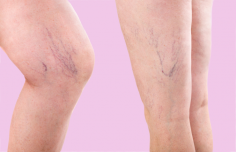 How do I get rid of spider veins on my legs?

Sclerotherapy is one of the best therapy for spider veins and a tiny bunch of leg veins. Multiple doses of a sclerosing agent are vaccinated into the irregular red, blue, or purple spider veins of the affected leg. 
