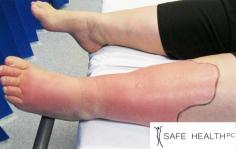 Cellulitis is a common infection of the skin and the soft tissues underneath. Safe Health & Med Spa is well-equipped to diagnose and treat cellulitis, and we can develop a treatment plan based upon your needs. For more information, visit our website.