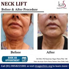 A neck lift, or lower rhytidectomy, is a surgical procedure that improves visible signs of aging in the jawline and neck.

Visit: https://www.imageclinic.org/neck-lift-surgery.html

#necklift #neckliftsurgerycost #plasticsurgerydelhi #imageclinic #neckliftsurgeondelhi #cosmeticsurgeryindia

