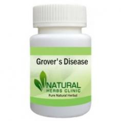 Herbal Treatment for Grover’s Disease read about Symptoms and Causes. Natural Remedies for Grover’s Disease and Supplement may provide relief from itching and irritation.
https://www.naturalherbsclinic.com/product/grovers-disease/
