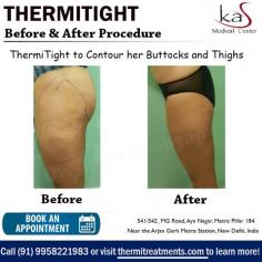 ThermiTight is a good option for patients that have mild to moderate skin laxity and want to achieve dramatic results without the risk or downtime of surgery.
ThermiTight can be used on areas of the face or body, including:
• Lower face
• Neck
• Breasts
• Upper Arms
• Tummy
• Back
• Thighs/Knees

If you are thinking about getting a thermitight procedure in Delhi, set up an appointment with Dr. Ajaya Kashyap and discuss it. 

Dr. Ajaya Kashyap Triple American Board certified Plastic Surgeon with over 35 years of experience. He practices state of the art Plastic and Cosmetic Surgery in South Delhi and Gurugram areas, making cutting edge advances in Aesthetic Surgery. He is currently the Medical Director of KAS Medical Center and Director of Plastic Surgery at MedSpa, New Delhi, India.

You can learn more about on his website - https://www.thermitreatments.com/thermitight.html

We are offering VIRTUAL CONSULTATIONS so that we can all stay connected during this time!

#thermitight #skintightning #nonsurgical #jowls #doublechin #armlift #facelift #necklift #breastlift #thighlift #kneelift
