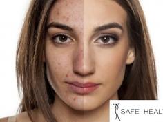 At Safe Health & Med Spa Mt Pleasant and Lansing Dermatology treat acne scarring and acne breakouts. Dr. Saif Fatteh, our dermatologist for acne describes the best way to understand acne which is to think about the roles your hair follicles and pores play in maintaining healthy skin.