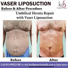 Looking for Best Vaser Liposuction Surgery in Delhi, India at Affordable Cost? KAS Medical Center has expert Liposuction Surgeon in Gurgaon, Delhi NCR. For any kind of enquire about hernia repair with vaser liposuction surgery please complete .

Dr. Ajaya Kashyap Triple American Board certified Plastic Surgeon with over 30 years of experience in which 16 years in the U.S.A. & from the past 14 years he is in Delhi. You can learn more about on his website - www.bestliposuctionindia.com

We are offering ONLINE VIDEO CONSULTATIONS so that we can all stay connected during this time!

#liposuctionsurgeon #vaseriposuction #bestliposuctionindia #herniarepair #cosmeticsurgery #plasticsurgeon #drkashyap #Delhi #India #medicaltourism
