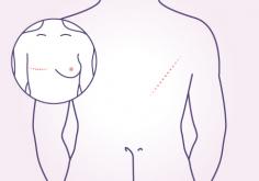 Latissimus dorsi(LD) flap reconstruction | Dr. Deepak Jha