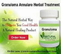 Granuloma annulare is very comparable the same to psoriasis in that together is incendiary immune system matter of the skin. We utilize the Natural Remedies for Granuloma Annulare and the skin detox method for Natural Treatment for Granuloma Annulare .

http://herbsnaturalclinic.weebly.com/blog/utilize-natural-remedies-to-abolish-granuloma-annulare-skin-disease
