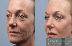 Fractional laser provides skin rejuvenation, skin resurfacing, tightening of the pores, reduction in scars and spots on the skin, and increase in skin quality. Safe Med Spa can customize treatment to accommodate your needs. The benefits of Safe Fractional Laser include increased patient comfort, shorter healing times and results that can range from subtle to dramatic.
