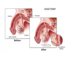 Vasectomy Video

The drive to resume sexual intercourse after a vasectomy video is caused by the excitement and hope to father a child again. Unless the patient reached the maximum level of comfort from reversing vasectomy, it is best to wait for the perfect time to resume sexual contact. While waiting, equip yourself with knowledge on how to promote sperm viability. Should you decide not to have children, or if you simply want to help your wife achieve a more successful form of birth control after all the methods used have been ineffective, you may opt to undergo male sterilization or what is commonly known as a vasectomy procedure. In this procedure, a part of the vas deferens is legated and transected. Your sexual potency and ability to ejaculate will not be affected by vasectomy, but sperm will not pass from your testes.

There are circumstances, however, such as the loss of a child, remarriage, or more stable finances that may make you want to father a child again. In this case, vasectomy can be undone using a process known as vasectomy. Tubes that carry sperm from the testicles to the semen are reconnected, resulting in having sperm in your ejaculation.

In most of the cases, men who have undergone a vasectomy are able to impregnate their partner. But, these percentages show that while most vasectomies can and do get reversed, it does not hold true for all men. While a vasectomy video procedure may be performed years after a vasectomy, data show that the longer the period that has elapsed between Georgia vasectomy, the specific procedure under the process as you can choose from two ways available to reverse a vasectomy procedure. This is a procedure in which the vas deferens is reconnected. If you still have sperm that will pass through at least one connection, then this is the preferred procedure of vasectomy. Since the reconnection must be as watertight and as precise as possible, the skill of the surgeon matters a lot in the success of the operation.

In this form of vasectomy procedure, the transected vas deferens is reconnected to it. Depending on the complexity of the operation, a vasectomy can occur anywhere from one to four hours, usually under a general or regional anesthesia. The first one is patency rate, which is measured by the return of moving sperm after the operation. Studies have shown that 80% of the men who have undergone Georgia vasectomy have sperm motility as early as three months after the operation, with of the men regaining sperm motility in their ejaculation within a year after the procedure. Unfortunately, the figures are not as successful for procedure. 

For More Info:- https://vasectomyclinicatlanta.com/
https://www.cleansway.com/georgia/business/vasectomy-clinic-atlanta
https://www.boulderdigitalarts.com/directory/listing.php?id=12249
https://www.citiwaka.com/georgia/business-services/vasectomy-clinic-atlanta
