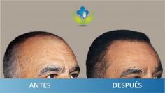 Colombia Care Hair Transplant Offers the Latest Hair Transplant Technology ARTAS in Medellin. Our Medellin hair transplant facilities are state of the art. With an average temperature of 24°C all year round, there is never a wrong period to visit us. 