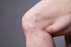 Laser Vein Removal Treatment Beneficial For Elderly

Is Laser Vein Removal Treatment Beneficial For The Elderly? Read our blog here for more information. Call us at Fox Vein & Laser Experts.
