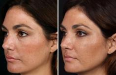 Restylane and Juvederm XC are a simple solution to the effects of aging. Used to treat and address static wrinkles, facial folds, and the loss of volume to the face that occurs with age, these injectable fillers create instant results without surgery.