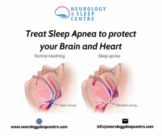 Sleep apnea can be an aftereffect of stroke, but can also be the cause of a first time or recurrent stroke.
Therefore treat Sleep Apnoea for a Healthy Heart.

visit our for more details: https://www.neurologysleepcentre.com/