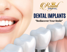 Great Way to Restore Your Smile

Are you ready to explore your tooth replacement options? Consult with our team. We are passionate about closing the gaps to the patient's teeth and make them smile confidently at a reasonable price. Send us an email at online@royaldentalusa.com for more details.

