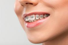 Have issues with your teeth aligning? We have specially trained orthodontists who provide orthodontic treatment to patients. In every routine dental check-up, your teeth’s alignment will be checked, options provided to prevent further complications at different stages of growth. Contact us for consultation now.