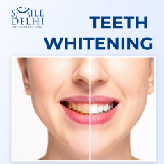 Teeth Whitening Near Me

Some people feel hesitant when they need to smile as their teeth are discolored or have a few stains. A teeth whitening procedure is the best option for them to bring a smile back to their face. Although a single treatment may be enough to solve all your discoloration issues, it is still recommended that you undergo at least one maintenance session every three months to ensure that your initial treatment results are consistent throughout time.

 Those who make use of professional teeth whitening treatments also need to note that during longer spans between treatments, it will be important for them to implement some habits into their daily routine that will help maintain their fresh smile. In addition, in-house kits can only go so far and having an understanding of how products like mouthwash or even food and drink influence the appearance of your pearly whites will prove crucial when you're on a strict budget. 