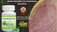 Helpful Home Remedies for Granuloma Annulare are very suitable option to fight against the symptoms and causes of the disease and provide relief from the disease.
https://www.naturalherbsclinic.com/blog/home-remedies-for-granuloma-annulare-tips-to-get-rid-of-skin-disease/
