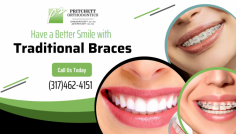 Correct Misalignment Problem with Traditional Braces

Do you want to straighten your smile with traditional braces? At Pritchett Orthodontics, we offer orthodontic treatment that can shift crooked teeth, fix gaps and correct overbites, underbites and cross bites problems. Contact us today at (317)462-4151!

