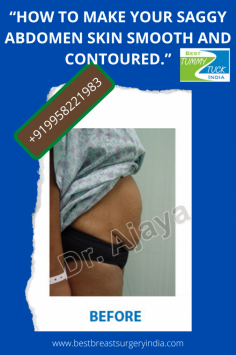 “How to make your saggy Abdomen skin smooth and contoured.” and how much it cost
 HERE YOU GET MORE INSIGHT - 
Call: +919958221983, 9289988888
website: www.besttummytuckindia.com