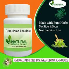 Best Natural Remedies for Granuloma Annulare Natural Cure Natural Remedies for Granuloma Annulare are purely made with herbal ingredients and have no kinds of negative effects to use then buy our herbal products online and get complete relief from the Granuloma Annulare skin infection and disease. https://www.naturalherbsclinic.com/product/granuloma-annulare/