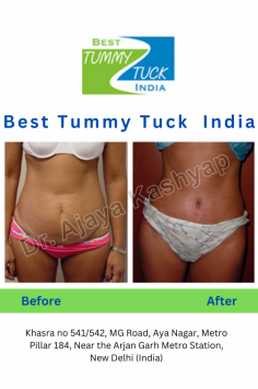 Tummy tuck surgery benefits a person having loose or sagging skin after pregnancy or major weight loss. A person with severe laxity of their abdomen muscles and having excessive skin will be the right for full tummy tuck. 

More at: http://www.besttummytuckindia.com/

Call at: +91-981-836-9662, 995-822-1983