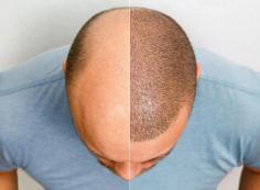 Orlando is a great vacation spot in the United States and best Choice for people who are suffering from hair loss.
The future of hair restoration is now available with modern, technologic follicle unit extraction implants. Our doctor uses this innovative approach to provide clients struggling from androgenetic alopecia the best results possible by restoring their natural appearance through FUE Hair Transplant!
