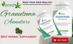 Here we will discuss five natural treatments that can help you to Get Rid of Granuloma Annulare Naturally.
