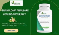 In this blog post, we will explore four tips for treating granuloma annulare naturally from the comfort of your own home.
