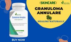 In this blog post, we will look at how to treat granuloma annulare at home completely without any side effects.
