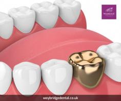 Gold dental crown On The NHS is popular choice for many people, as they are strong and durable, and can last for many years with proper care. A gold dental crown is a type of dental restoration that is used to cover a damaged or decayed tooth, in order to protect it from further damage and restore its appearance. They are widely available in the NHS system. 

When considering a gold dental crown on the NHS, it is important to first understand the criteria for receiving treatment. In the UK, the National Health Service (NHS) provides a wide range of dental services, but not all treatments are available on the NHS. The availability of a specific treatment will depend on the individual case and the clinical need. 

If you need a gold dental crown, the first step is to visit your NHS dentist. They will examine your teeth and determine whether a gold dental crown is a right choice for you. If it is, they will then take X-rays of your teeth and take impressions, which will be used to create a custom-made gold dental crown. 

The process of getting a gold dental crown on NHS involves two appointments. During the first appointment, your dentist will prepare your tooth by removing any decay or damage and then will take an impression of your tooth. This impression will be sent to a dental laboratory, where your gold dental crown will be made. 

On the second appointment, your dentist will place the gold dental crown on your tooth and check the fit, shape and colour to make sure it is a perfect match to your teeth and bite.  

It's important to note that gold dental crowns are not suitable for everyone, and your dentist will discuss the most suitable options with you based on your specific needs and budget. Your NHS dentist may offer other options such as porcelain fused to metal, resin, or ceramic. 

Caring for your gold dental crown is similar to caring for your natural teeth. Good oral hygiene, including regular brushing and flossing, will help to ensure that your gold dental crown lasts for many years. It's also important to attend regular check-ups with your NHS dentist to ensure that your gold dental crown is in good condition and that your oral health is maintained. 

In conclusion, gold dental crowns are an excellent choice for those who need to restore a damaged or decayed tooth. They are available on the NHS and provide a strong, durable and long-lasting solution for dental problems. With the proper care and regular check-ups, your gold dental crown on NHS, giving you a healthy and beautiful smile.

