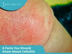 1. Any Break or Cut in the Skin can Open the Door to a Cellulitis Infection 
2. Cellulitis and Cellulite Aren’t the Same 
3. History of Getting Cellulitis Increases the Risk of Developing it Again 
4. Cellulitis Is Not Usually Contagious 
5. Cellulitis Infection Can Develop Anywhere on Your Body 
6. Cellulitis Infection can be Life-Threatening
