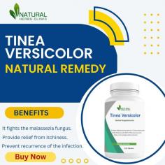If you’re looking for natural treatments and Home Remedies for Tinea Versicolor, then look no further than Natural Herbs Clinic.
