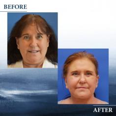 Full facelift and upper blepharoplasty before and after!

If you didn't catch her post-op story head to our last REEL! She was so self conscious of her chin and neck area .and this is just two month post-op. She is LOVING her new refreshed look, her eyes are so much brighter and wider, and she no longer has to worry about her sagging skin.