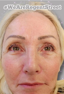 Profhilo is an excellent alternative to dermal fillers for people wanting to reverse the signs of skin ageing, with dull or tired looking skin revitalised and rejuvenated with natural hyaluronic acid that is totally broken down once the rejuvenation has been stimulated.

Know more: https://www.regentstreetclinic.co.uk/profhilo/