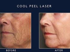 Revitalize your skin with CO2 laser resurfacing! This safe and effective cosmetic procedure uses laser technology to reduce the appearance of fine lines, wrinkles, age spots, and other skin imperfections. Say goodbye to damaged skin and hello to a smoother, healthier complexion. 