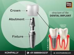 Dental Implant FMS Dental