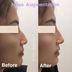 Richmond Cosmetic & Laser offers non-surgical nose augmentation, a non-invasive treatment that can reshape and enhance the appearance of the nose without surgery. This treatment is an excellent option for patients who want to make minor changes to the shape or size of their nose without the risks and downtime associated with surgery. The non-surgical nose augmentation treatment uses dermal fillers, such as hyaluronic acid-based fillers like Juvéderm or Restylane, to add volume and contour to the nose. The procedure is performed in-office by a skilled medical professional and takes less than an hour to complete.