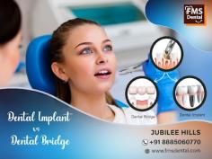 Dental Implant Vs Dental Bridge