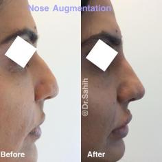 Richmond Cosmetic & Laser offers non-surgical nose augmentation, a non-invasive treatment that can reshape and enhance the appearance of the nose without surgery. This treatment is an excellent option for patients who want to make minor changes to the shape or size of their nose without the risks and downtime associated with surgery. The non-surgical nose augmentation treatment uses dermal fillers, such as hyaluronic acid-based fillers like Juvéderm or Restylane, to add volume and contour to the nose. The procedure is performed in-office by a skilled medical professional and takes less than an hour to complete.