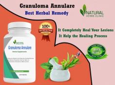 Granuloma Annulare at Home with natural remedies may offer several potential benefits. These remedies can provide a definitive recovery, they can help manage symptoms and promote healing process.
