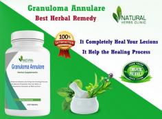 Here we are going to discuses some Natural Remedies for Granuloma Annuale that may help alleviate symptoms and promote healing.
