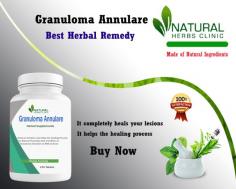 Here are some home remedies and self-care tips for Subcutaneous Granuloma Annulare Treatment Natural that you can consider.
