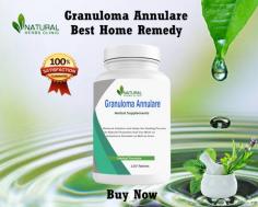 Discover Natural Cure for Granuloma Annulare at home options, such as turmeric, aloe vera gel, vitamin E oil, and essential oils. Alternative remedies to reduce inflammation and ease symptoms.
