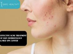 Get Clear, Beautiful Skin with Safe Dermatology & Med Spa's Acne Treatment. Our experienced dermatologists use advanced techniques to treat acne and give you the confidence you deserve. Book your appointment today and say goodbye to stubborn acne for good.
