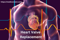 The Life-Saving Solution: Exploring Heart Valve Replacement

Discover the life-changing procedure of heart valve replacement, a surgical intervention that replaces damaged or diseased heart valves. To know about the types of heart valve replacements, the procedure itself, recovery, and potential risks. Stay informed and make informed decisions about your heart health.
https://med2connect.com/valve-replacement-2/






